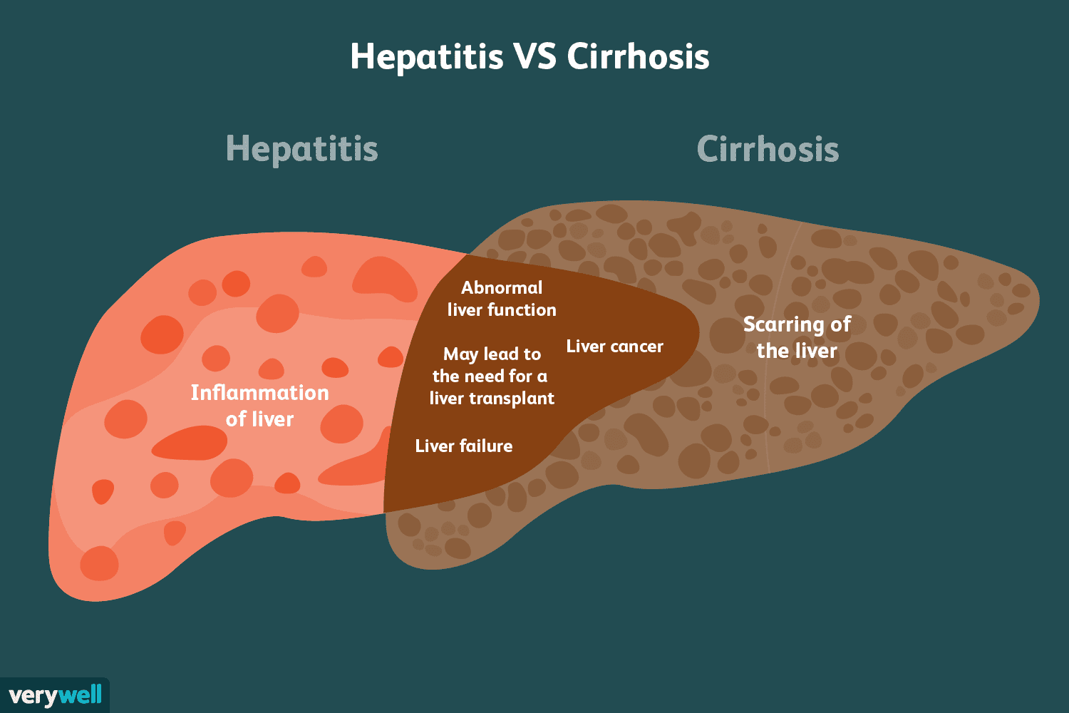 Can Viral Infections Like Hepatitis Cause Long-Term Liver Damage